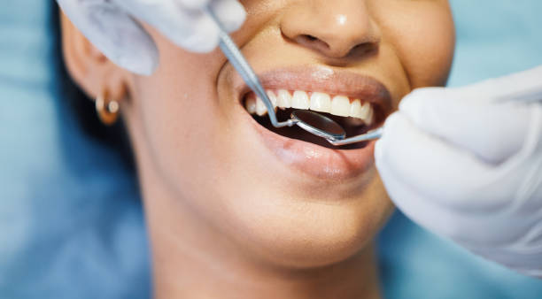 Best Knocked-Out Tooth (Avulsed Tooth) Treatment in Morton, PA